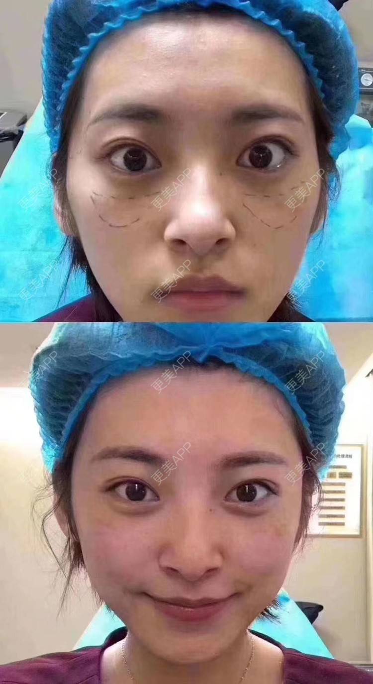 更美 - 郑州安美星河的双眼皮经验 | 双眼皮 | 注射美白 | 水光项目 | 隆鼻 | 郑州