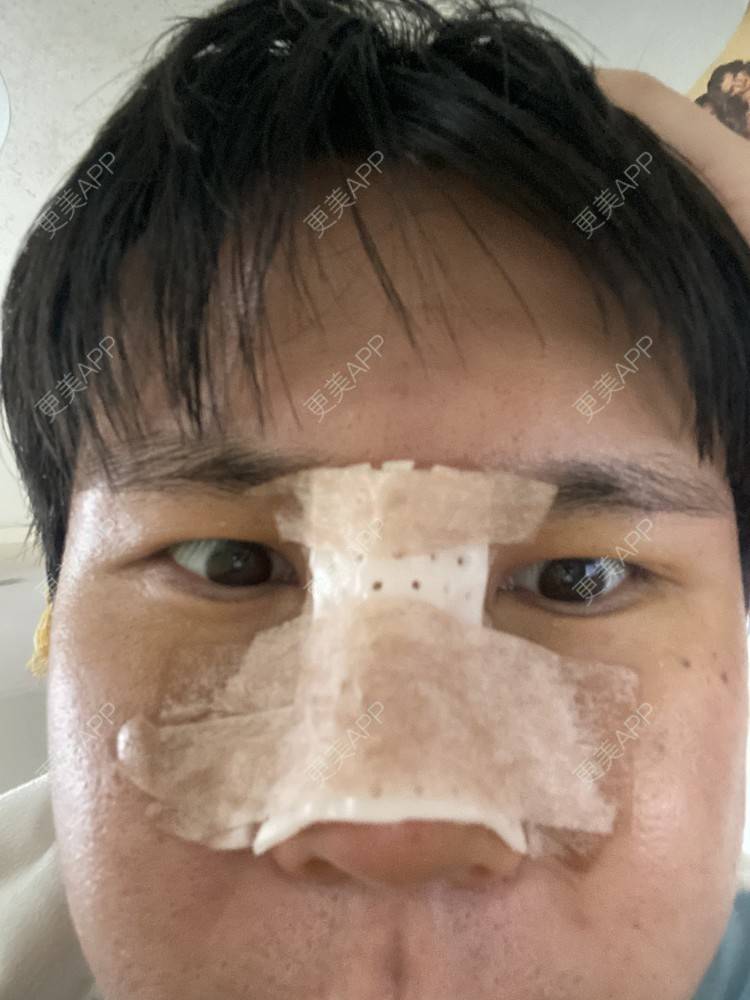 更美 - 冯仕琪的耳软骨隆鼻经验 | 济南 | 耳软骨隆鼻