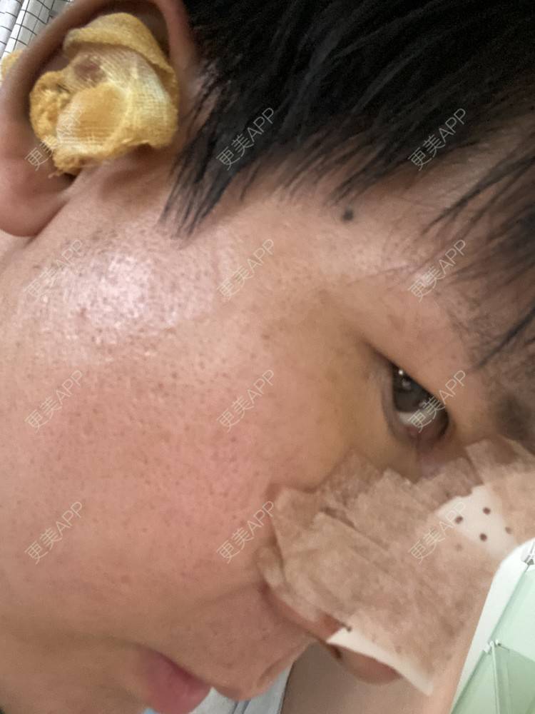 更美 - 冯仕琪的耳软骨隆鼻经验 | 济南 | 耳软骨隆鼻
