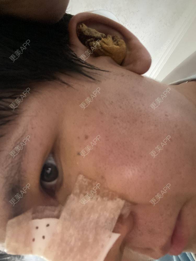 更美 - 冯仕琪的耳软骨隆鼻经验 | 济南 | 耳软骨隆鼻