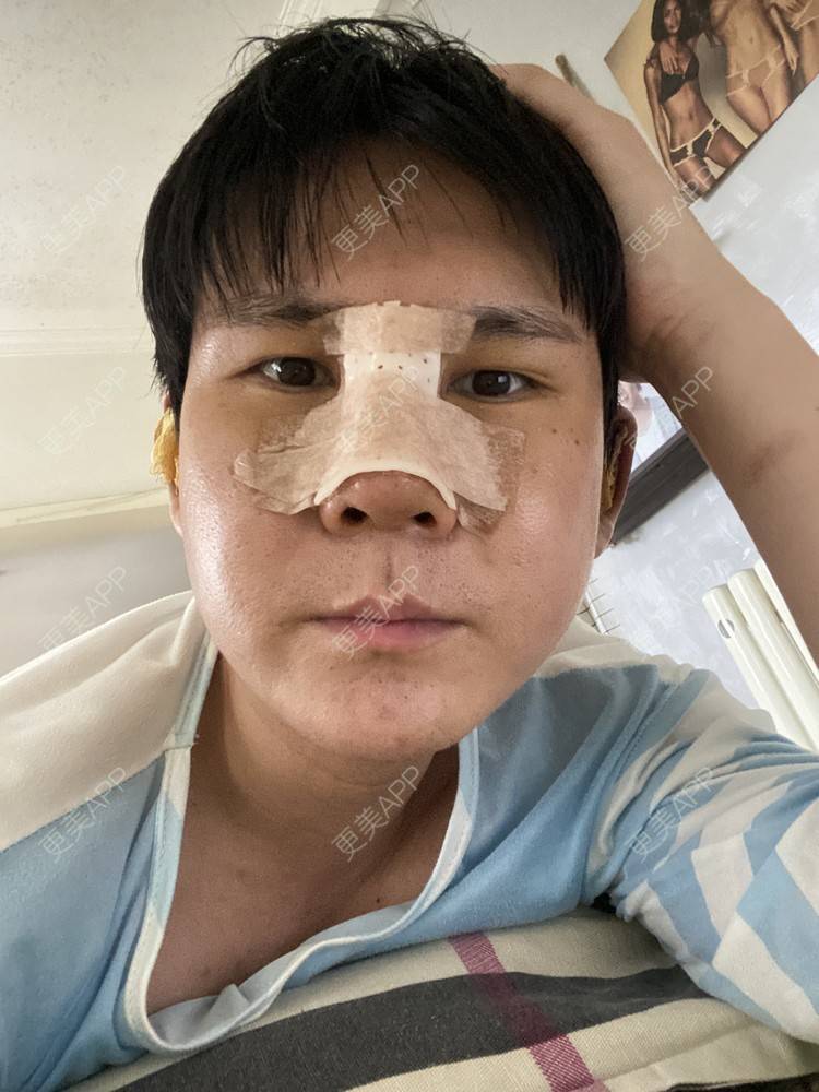 更美 - 冯仕琪的耳软骨隆鼻经验 | 济南 | 耳软骨隆鼻