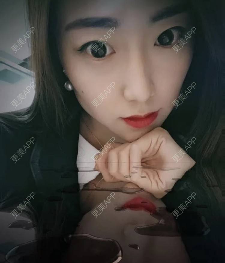 更美 - 繁星。。的埋线提升经验 | 埋线提升 | 南昌