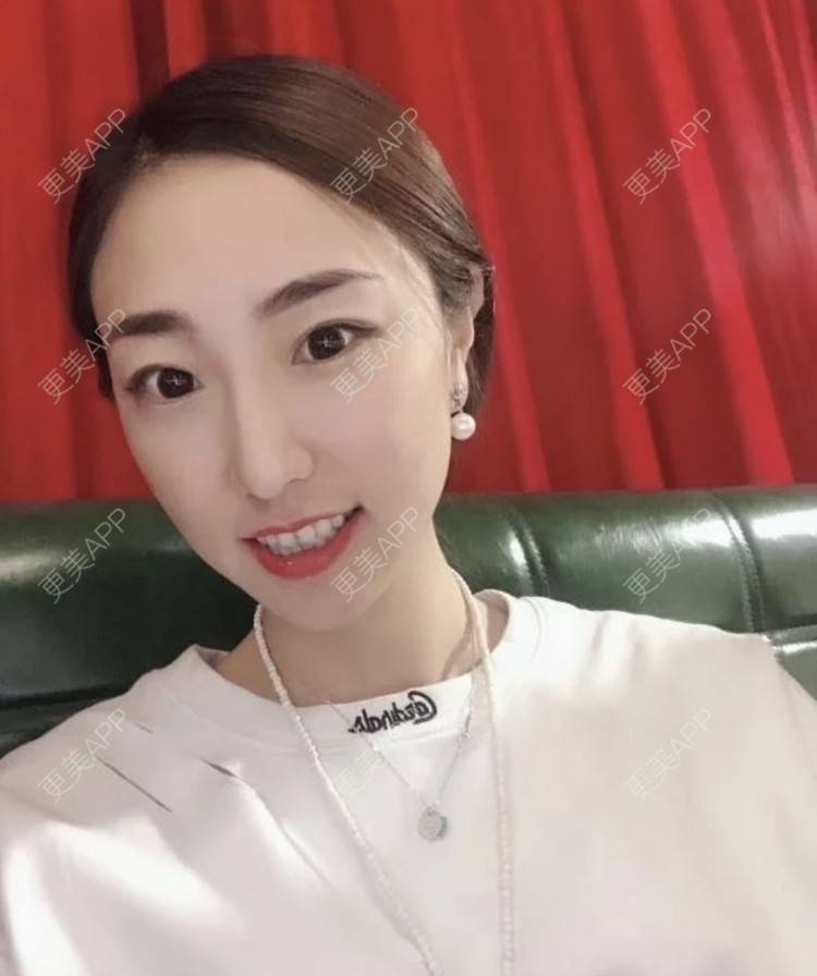 更美 - 繁星。。的埋线提升经验 | 埋线提升 | 南昌