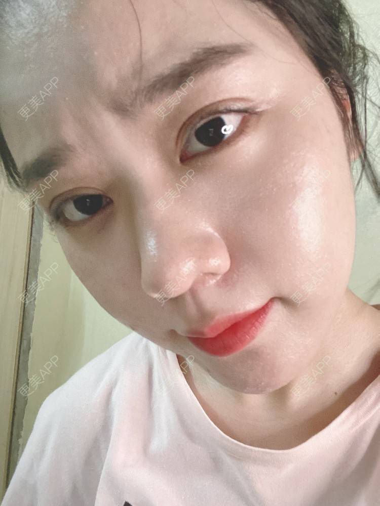 更美 - 更美用户Z50yfz3F6O的激光洗眉经验 | 广州 | 激光洗眉