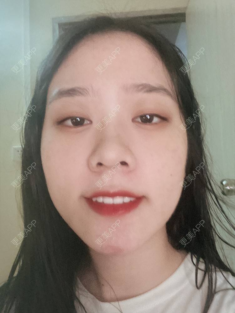 更美 - 更美用户Z50yfz3F6O的激光洗眉经验 | 广州 | 激光洗眉
