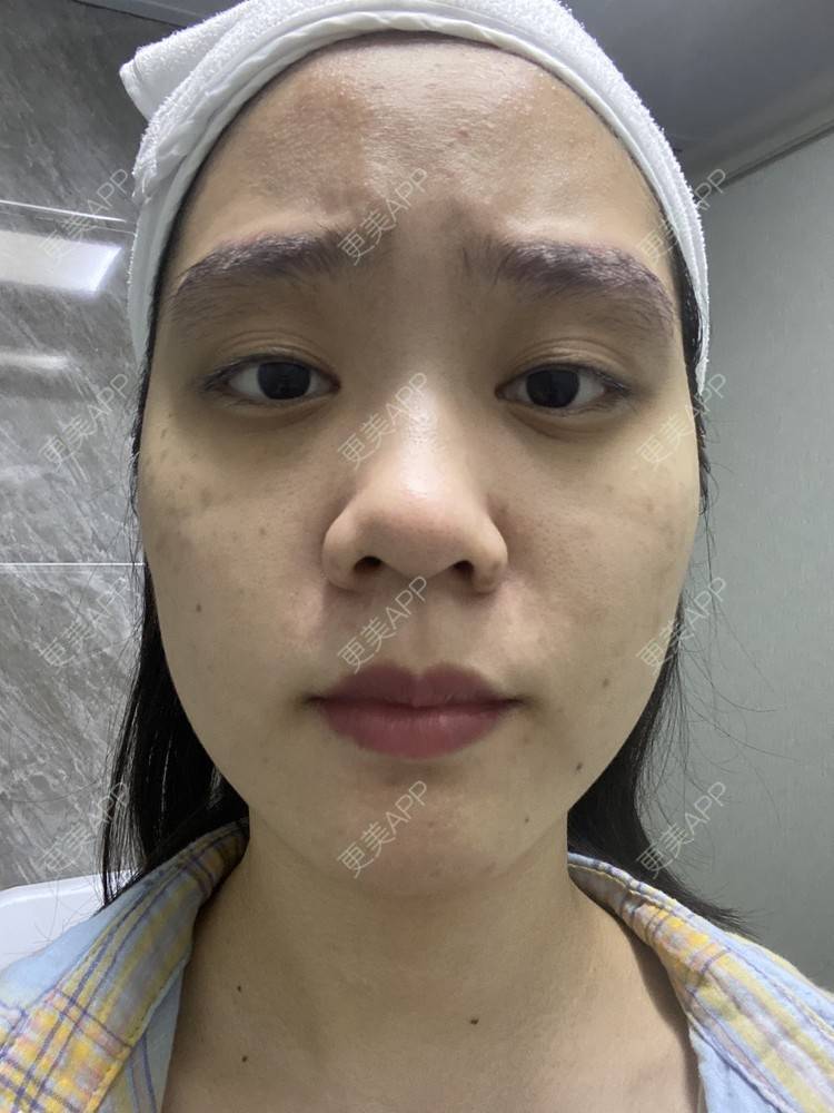 更美 - 更美用户Z50yfz3F6O的激光洗眉经验 | 广州 | 激光洗眉