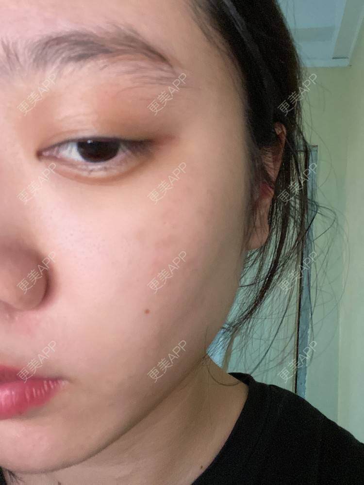 更美 - 更美用户Z50yfz3F6O的激光洗眉经验 | 广州 | 激光洗眉