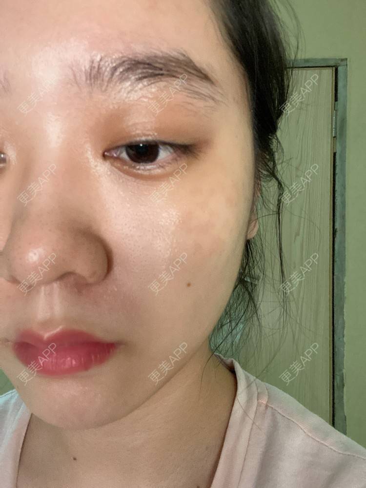 更美 - 更美用户Z50yfz3F6O的激光洗眉经验 | 广州 | 激光洗眉