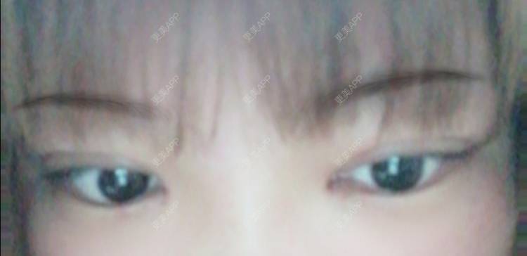 更美 - 更美用户DQNhAMm258的眼部多项经验 | 南京 | 眼部多项