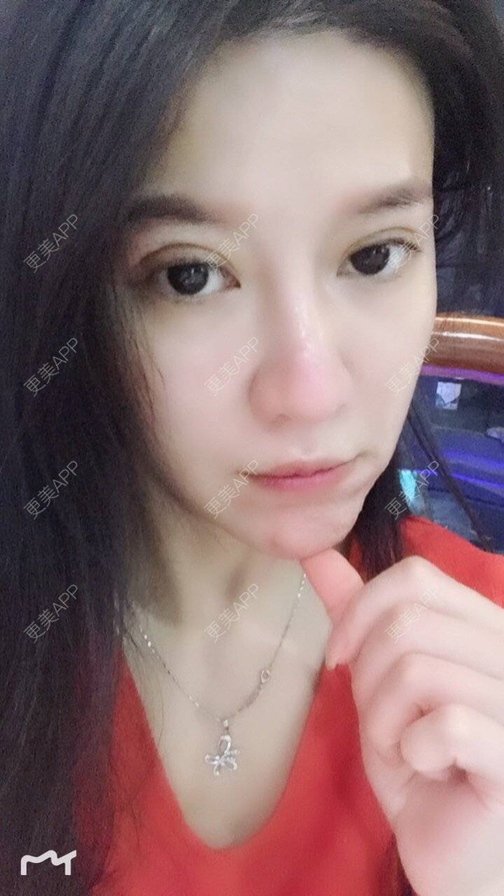更美 - 甘思佳的热玛吉经验 | 北京 | 热玛吉