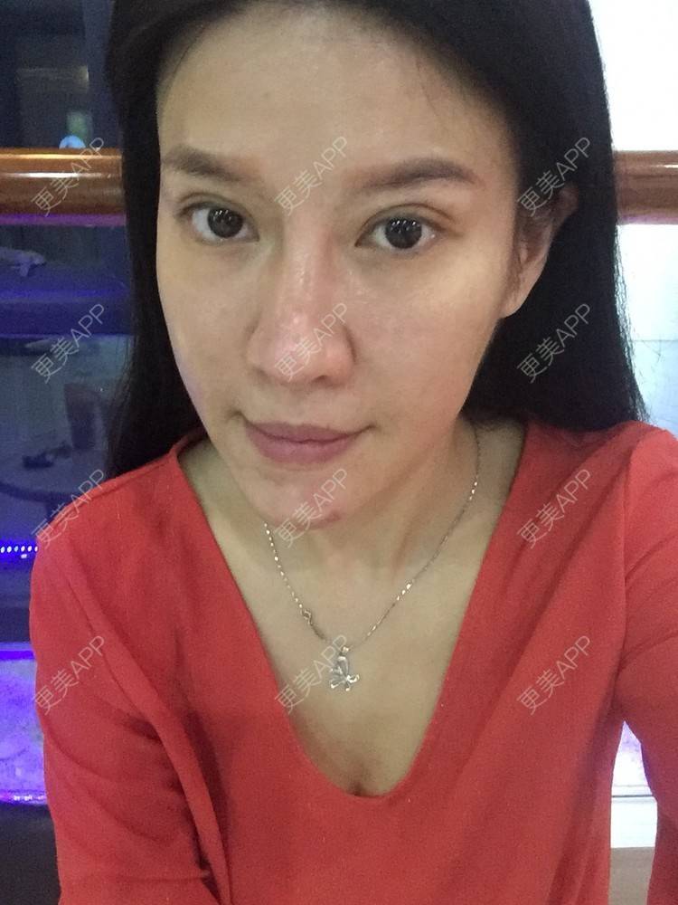 更美 - 甘思佳的热玛吉经验 | 北京 | 热玛吉