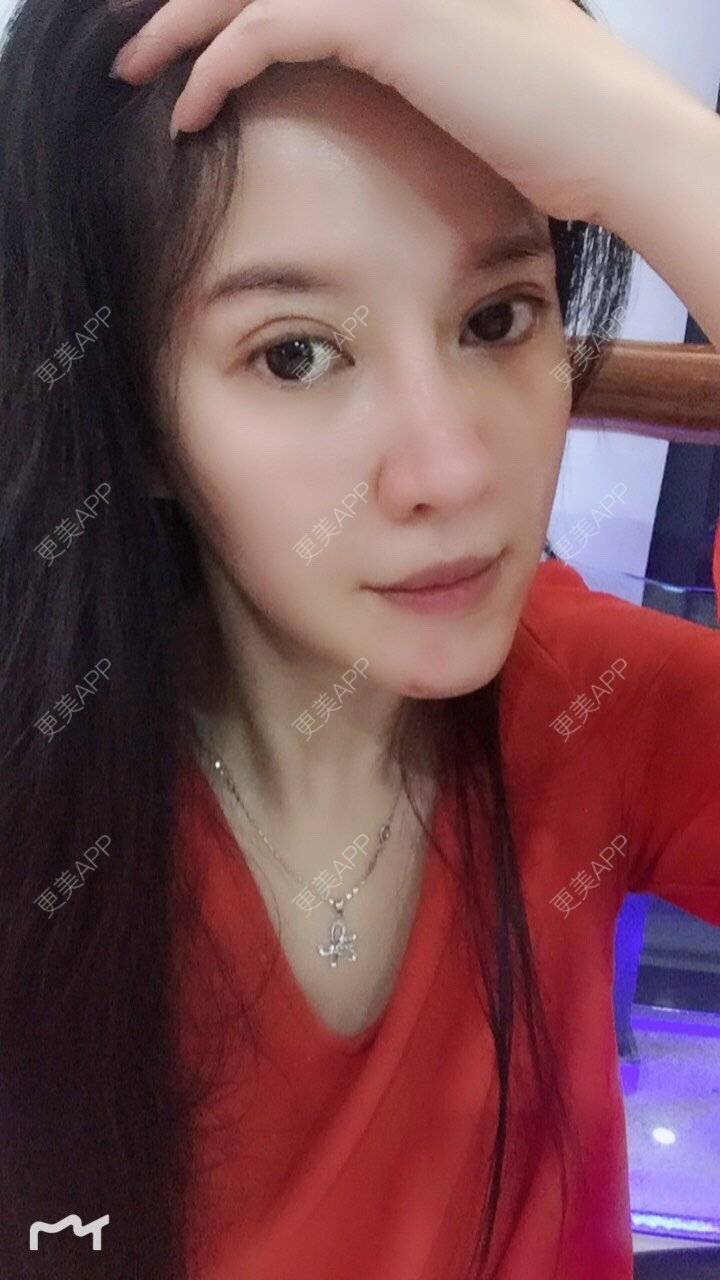 更美 - 甘思佳的热玛吉经验 | 北京 | 热玛吉