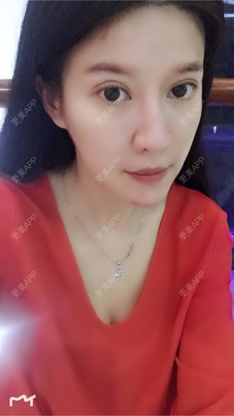 更美 - 甘思佳的热玛吉经验 | 北京 | 热玛吉