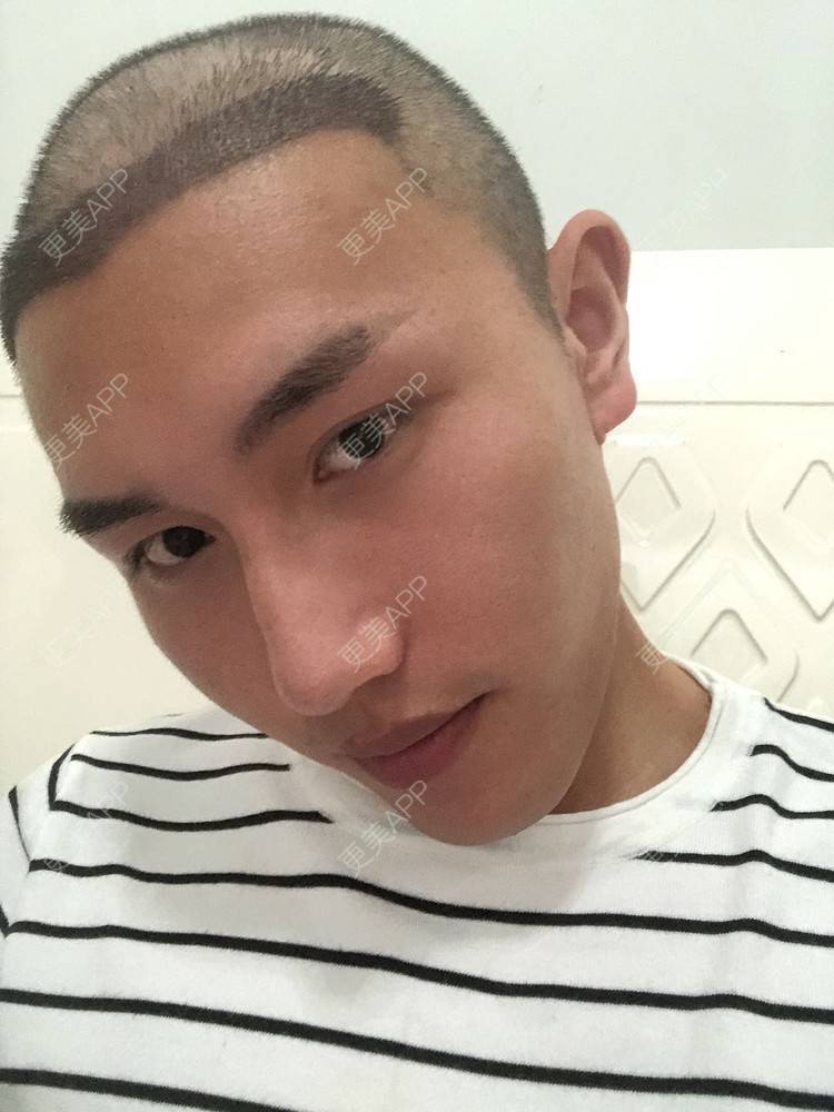 更美 - D调··的植发际线经验 | 植发际线 | 成都