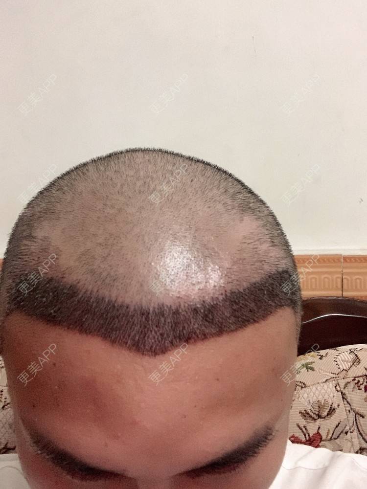 更美 - D调··的植发际线经验 | 植发际线 | 成都