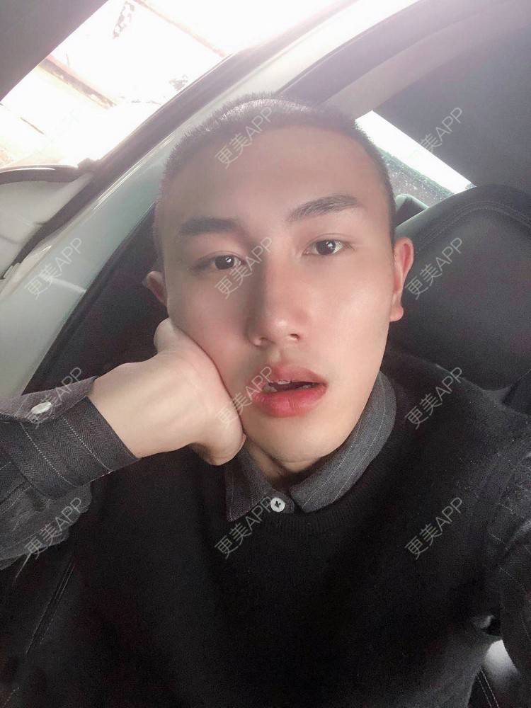 更美 - D调··的植发际线经验 | 植发际线 | 成都