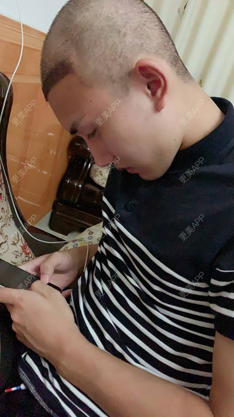 更美 - D调··的植发际线经验 | 植发际线 | 成都