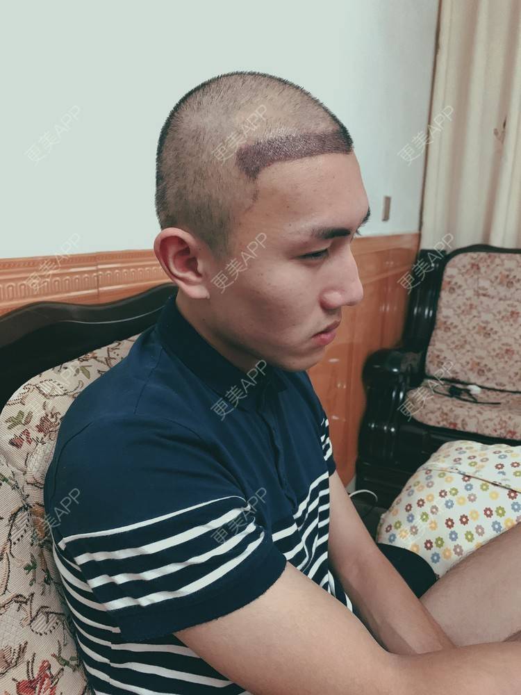 更美 - D调··的植发际线经验 | 植发际线 | 成都