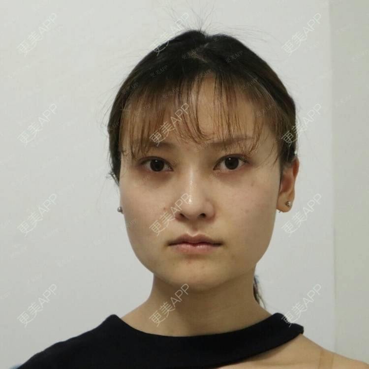 更美 - 行▍24°温暧。.的下颌角整形经验 | 颧骨提高 | 颧弓降低 | 颧骨颧弓整形 | 下颌角切除 | 下颌角整形 | 颧骨内推 | 轮廓修复术 | 视频日记 | 成都