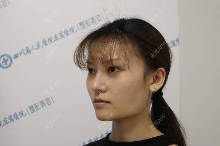 更美 - 行▍24°温暧。.的下颌角整形经验 | 颧骨提高 | 颧弓降低 | 颧骨颧弓整形 | 下颌角切除 | 下颌角整形 | 颧骨内推 | 轮廓修复术 | 视频日记 | 成都