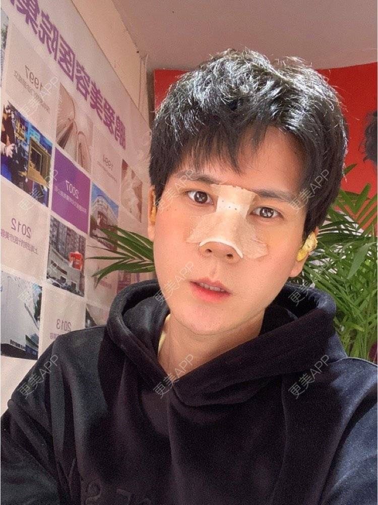 更美 - 冯仕琪的耳软骨隆鼻经验 | 济南 | 耳软骨隆鼻