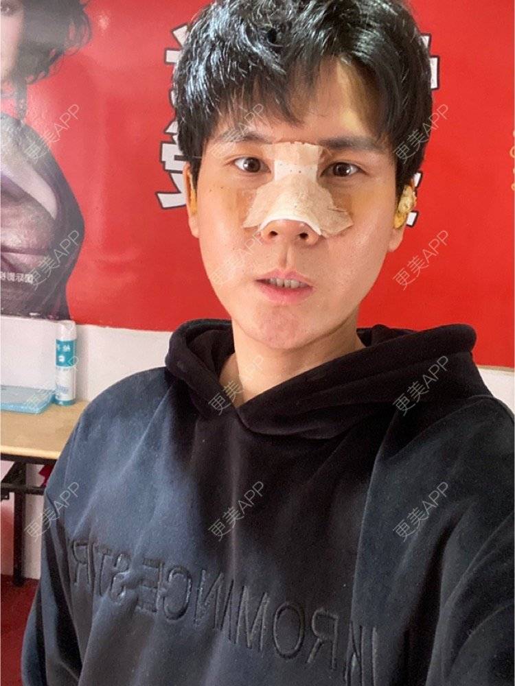 更美 - 冯仕琪的耳软骨隆鼻经验 | 济南 | 耳软骨隆鼻