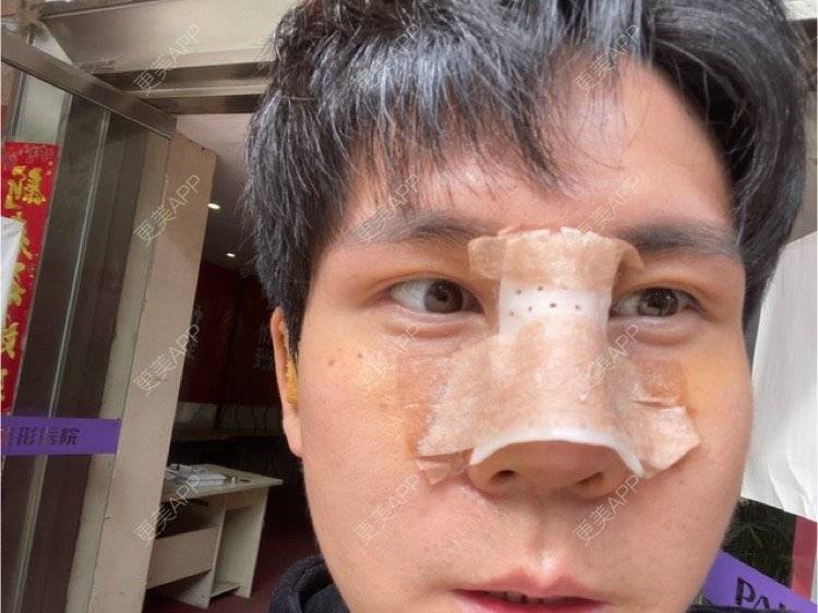 更美 - 冯仕琪的耳软骨隆鼻经验 | 济南 | 耳软骨隆鼻