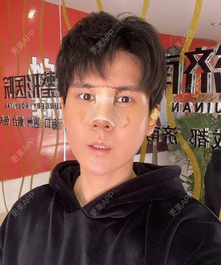 更美 - 冯仕琪的耳软骨隆鼻经验 | 济南 | 耳软骨隆鼻