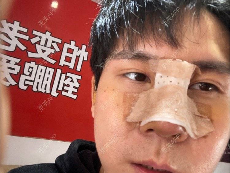 更美 - 冯仕琪的耳软骨隆鼻经验 | 济南 | 耳软骨隆鼻