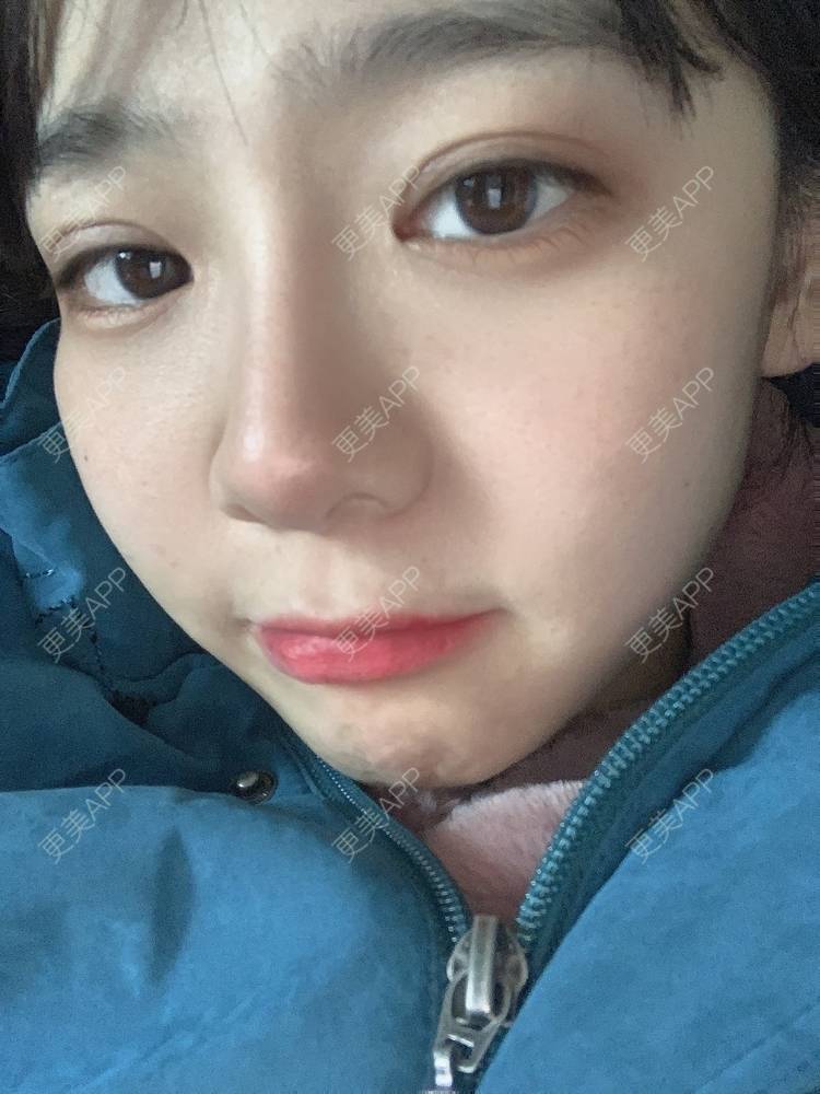 更美 - 更美用户x2P1rJphzv的全切双眼皮经验 | 全切双眼皮 | 重庆