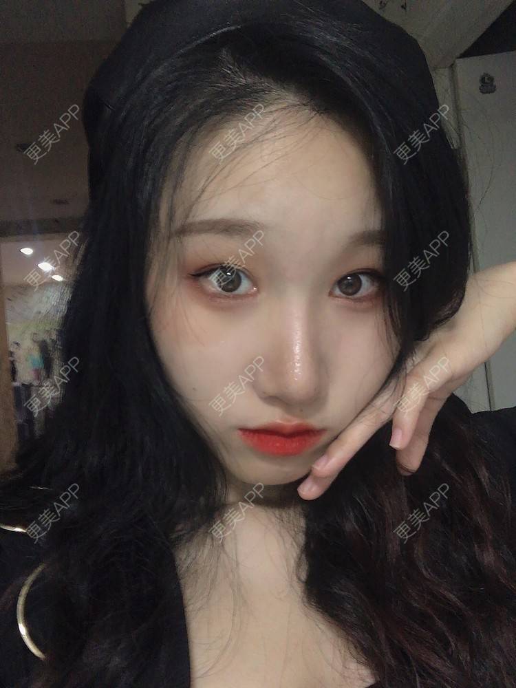更美 - 荏苒时光岁月如梭的鼻部多项经验 | 鼻部多项 | 肋软骨隆鼻 | 重庆 | 鼻小柱延长