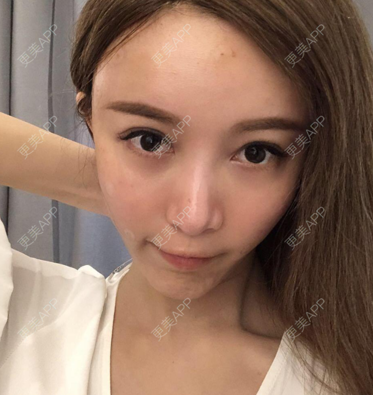 更美 - 手指间,心痛惶的自体脂肪填充泪沟经验 | 自体脂肪填充泪沟 | 自体脂肪丰面颊 | 北京 | 自体脂肪丰额头 | 自体脂肪丰苹果肌 | 自体脂肪丰卧蚕