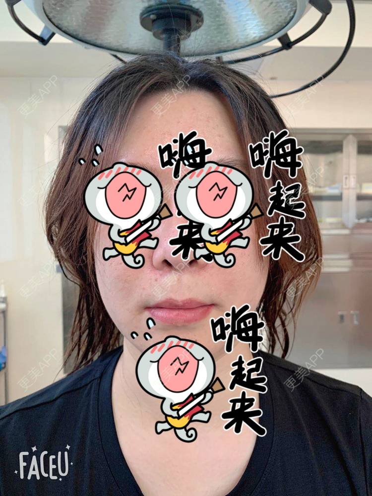 更美 - 更美用户wfRXvUvAU0的唇腭裂修复经验 | 唇腭裂修复 | 蚌埠