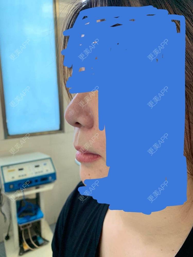 更美 - 更美用户wfRXvUvAU0的唇腭裂修复经验 | 唇腭裂修复 | 蚌埠