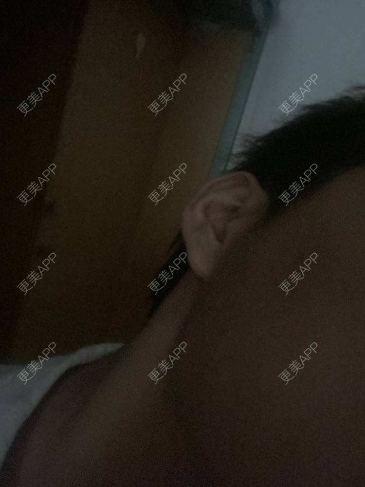 更美 - Phoebus的除皱瘦脸经验 | 除皱瘦脸 | 重庆