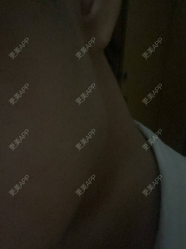 更美 - Phoebus的除皱瘦脸经验 | 除皱瘦脸 | 重庆