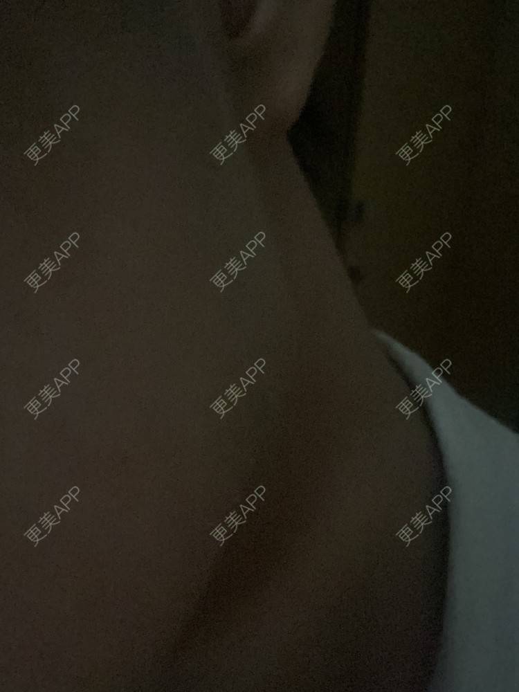 更美 - Phoebus的除皱瘦脸经验 | 除皱瘦脸 | 重庆