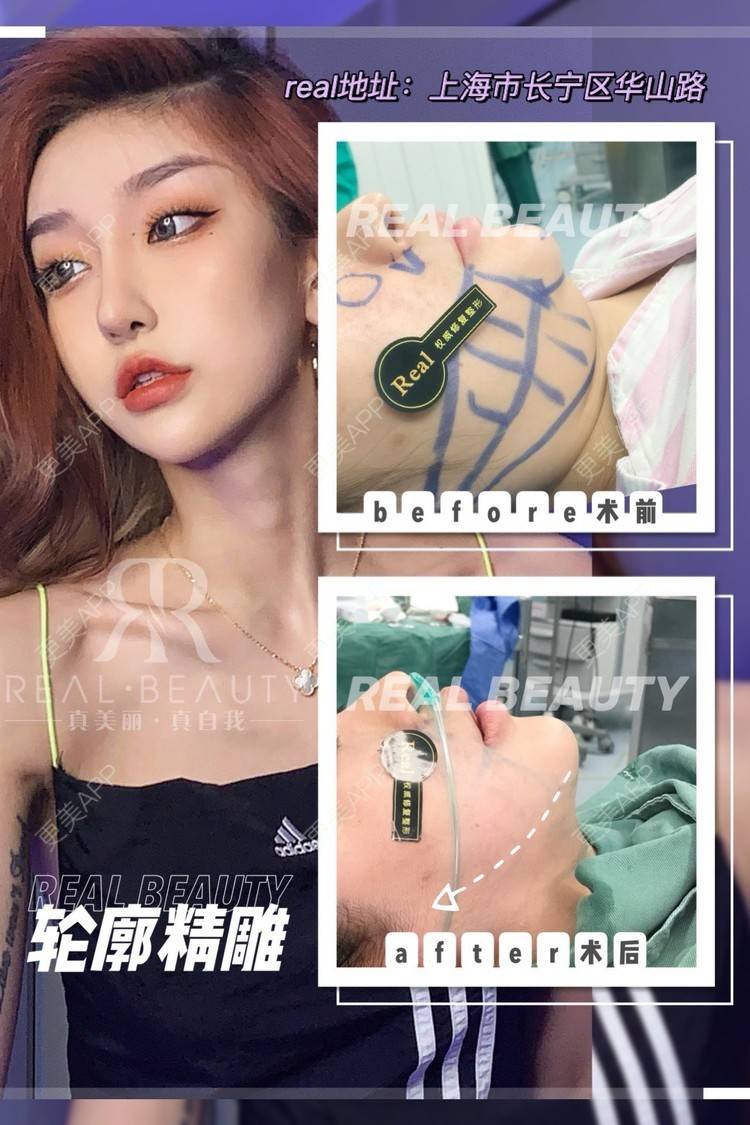 更美 - Luna4581的激光溶脂瘦脸经验 | 激光溶脂瘦脸 | 上海