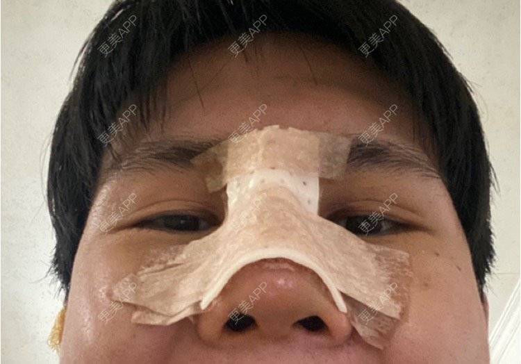 更美 - 冯仕琪的耳软骨隆鼻经验 | 济南 | 耳软骨隆鼻