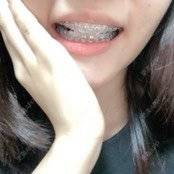 更美 - 更美用户n8XFkCxH2q的金属托槽矫正经验 | 金属托槽矫正 | 上海