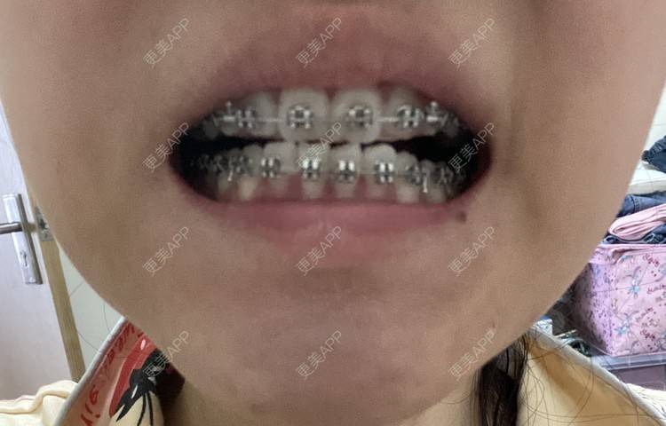 更美 - 更美用户n8XFkCxH2q的金属托槽矫正经验 | 金属托槽矫正 | 上海