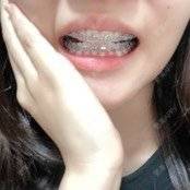 更美 - 更美用户n8XFkCxH2q的金属托槽矫正经验 | 金属托槽矫正 | 上海