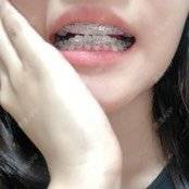 更美 - 更美用户n8XFkCxH2q的金属托槽矫正经验 | 金属托槽矫正 | 上海