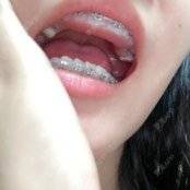 更美 - 更美用户n8XFkCxH2q的金属托槽矫正经验 | 金属托槽矫正 | 上海