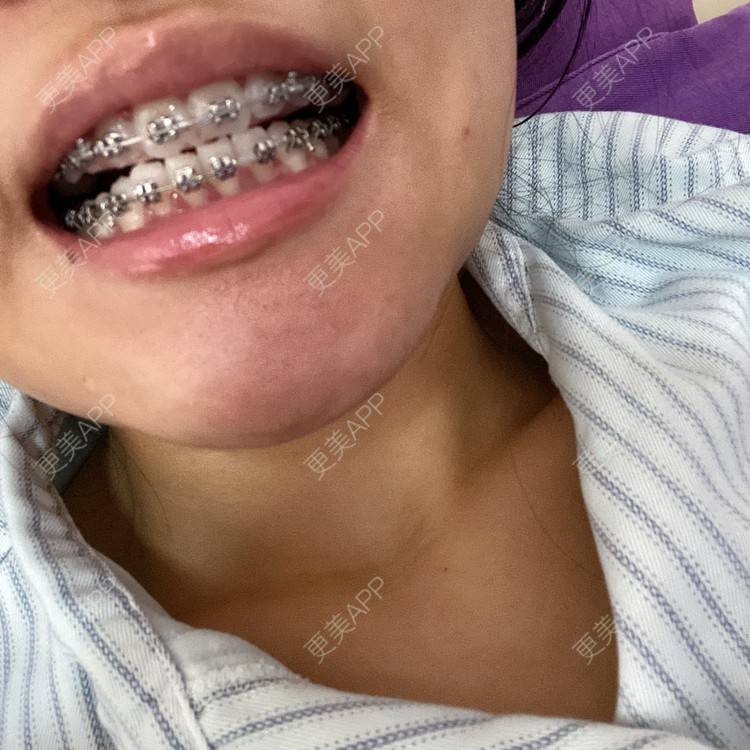 更美 - 更美用户n8XFkCxH2q的金属托槽矫正经验 | 金属托槽矫正 | 上海