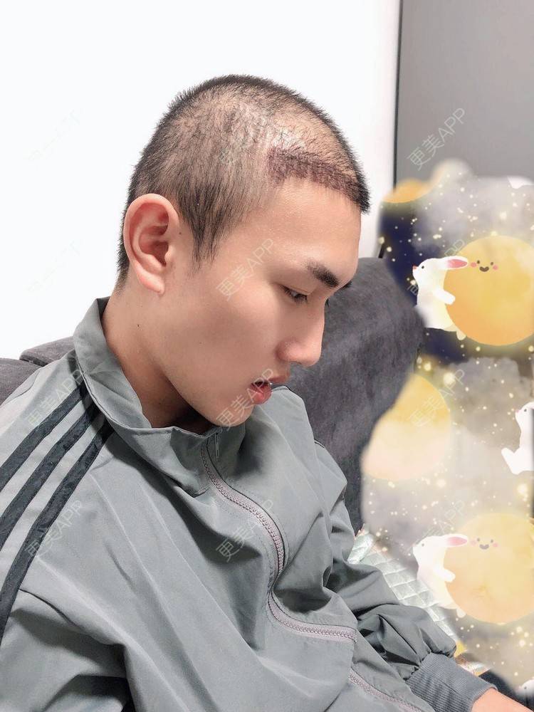 更美 - D调··的植发际线经验 | 植发际线 | 成都