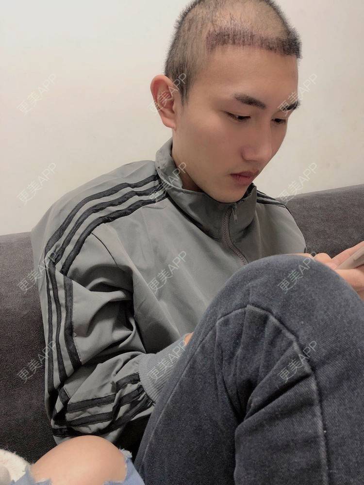 更美 - D调··的植发际线经验 | 植发际线 | 成都