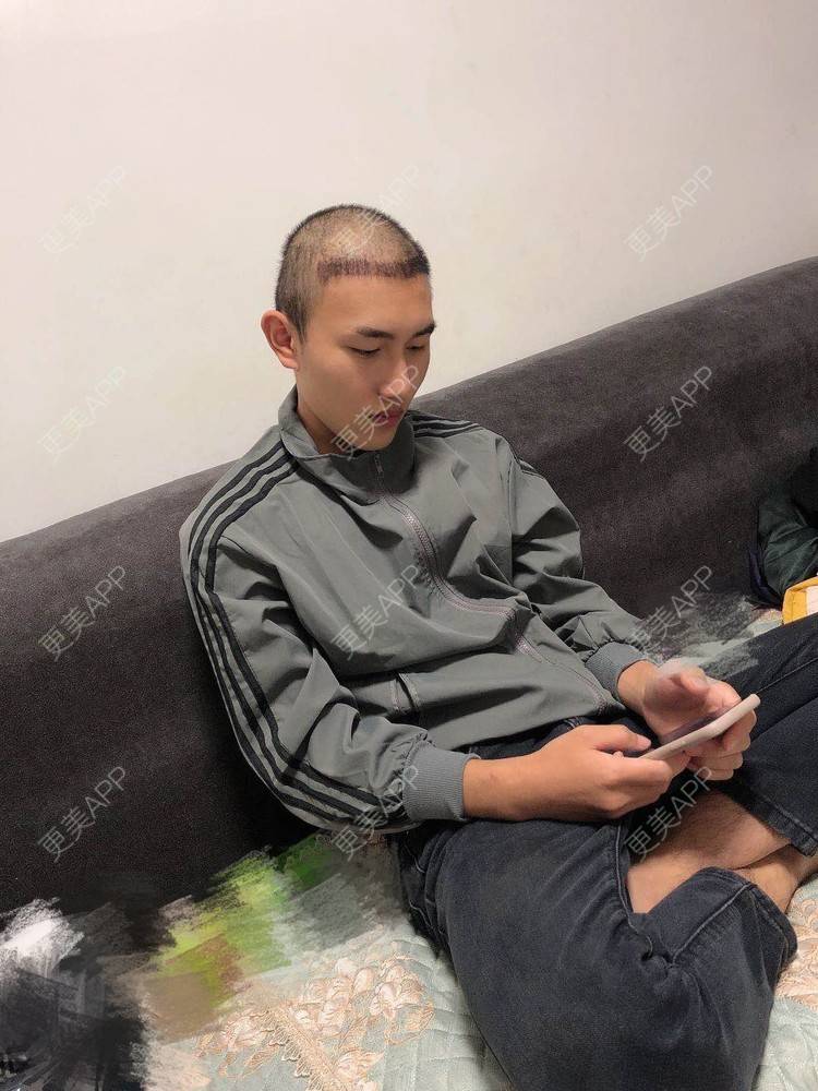 更美 - D调··的植发际线经验 | 植发际线 | 成都