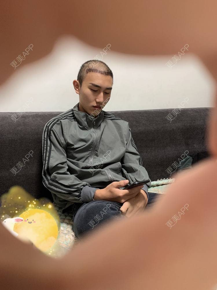 更美 - D调··的植发际线经验 | 植发际线 | 成都