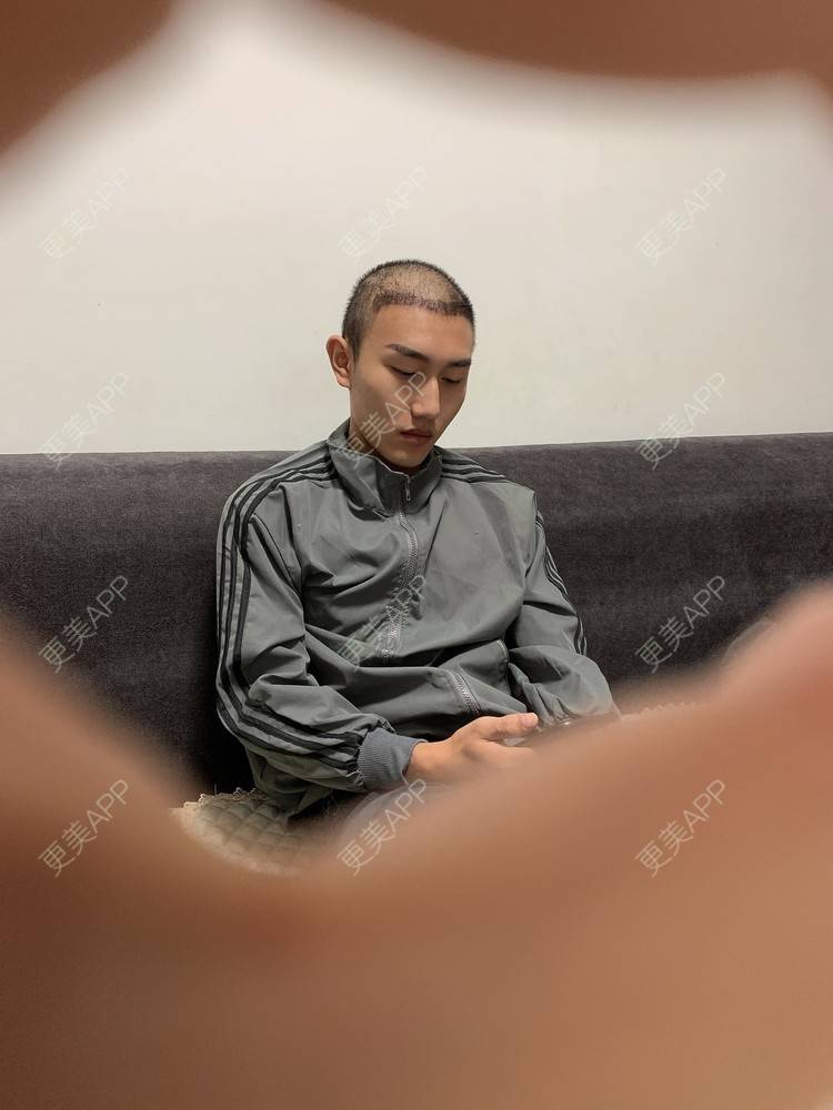 更美 - D调··的植发际线经验 | 植发际线 | 成都